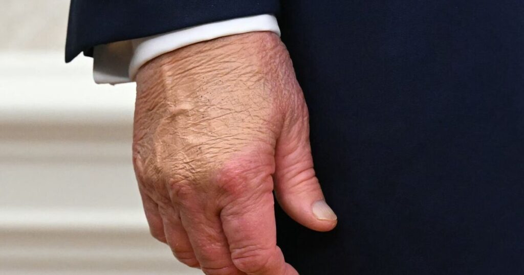 Die Gesundheitsängste von Donald Trump nehmen zu, als „starkes Make-up“ auf den Händen entdeckt wurde | Welt | Nachricht